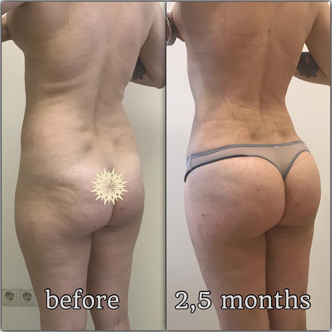 Липоскульптура у Фуада Фархата