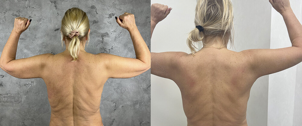 Пластика после похудения помогает убрать лишнюю кожу не только на животе, но и на других частях тела, например, на руках