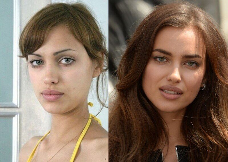 Ирина Шейк до&nbsp;и&nbsp;после пластики
