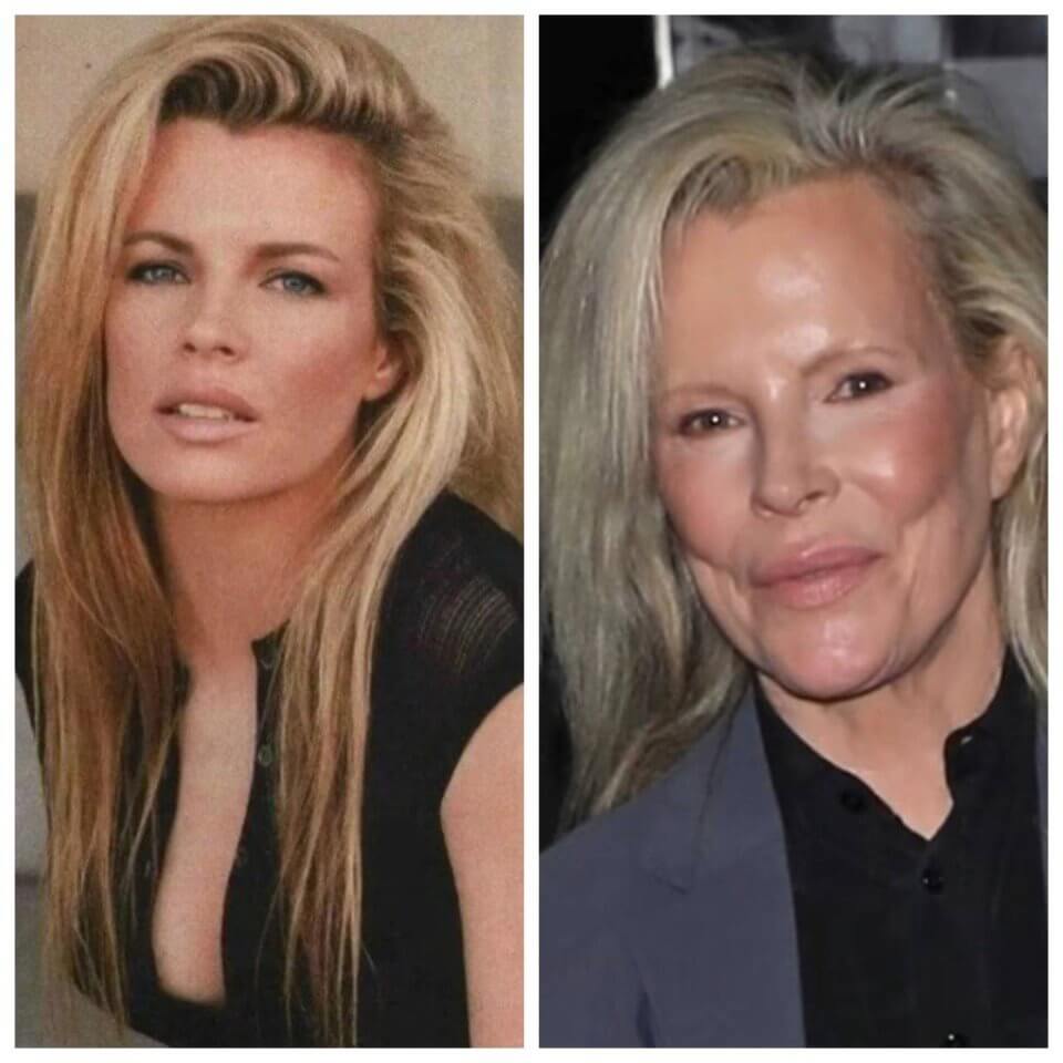 Ким Бейсингер до&nbsp;и&nbsp;после пластики