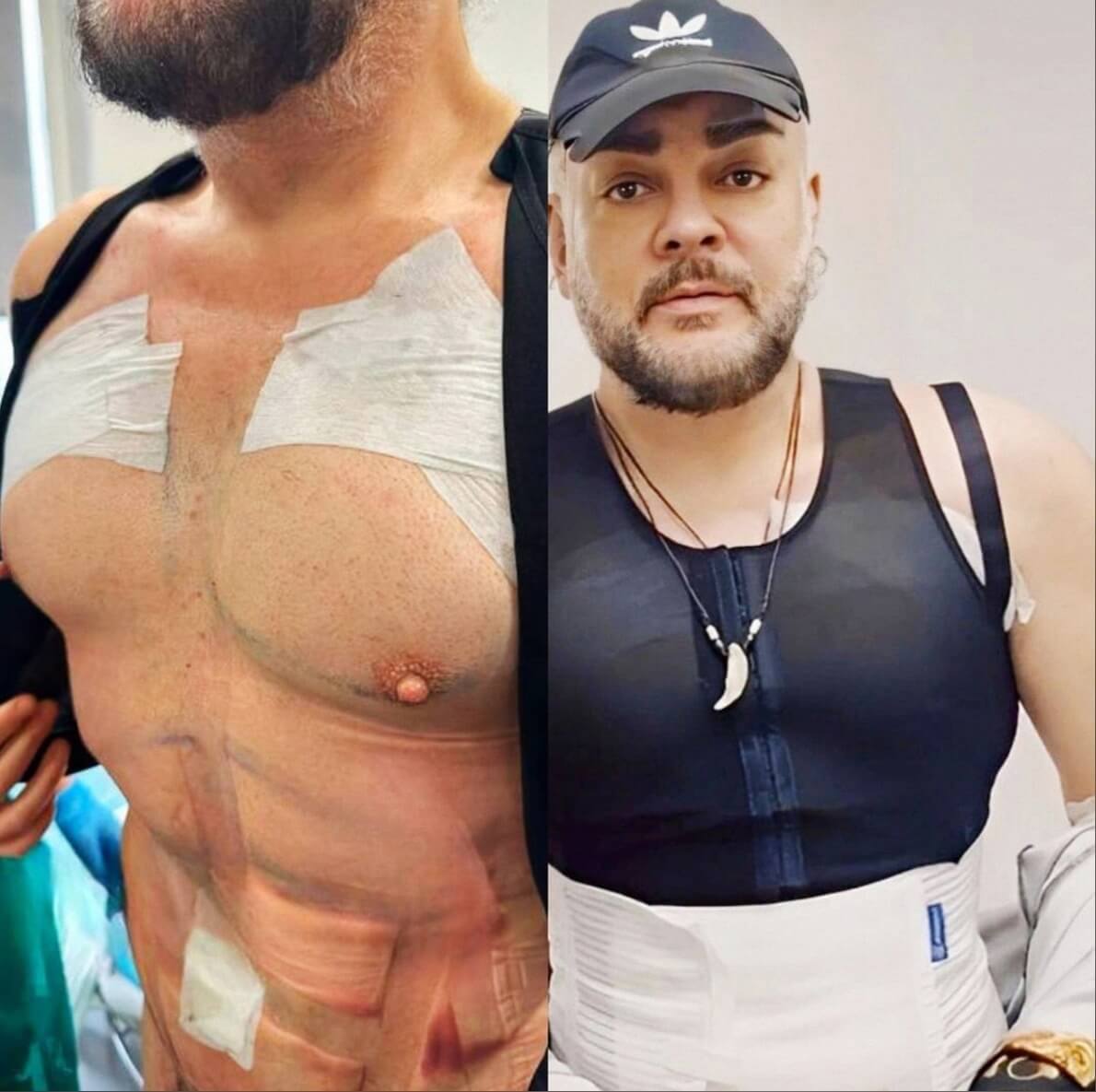 Филипп Киркоров после пластики в&nbsp;2023 году