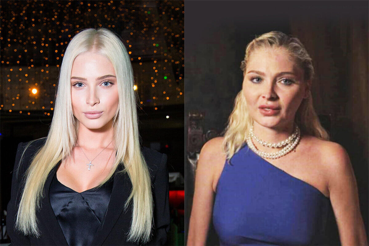 Алена Шишкова до&nbsp;и&nbsp;после пластики