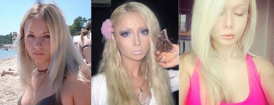 Аматуе скулы До и После