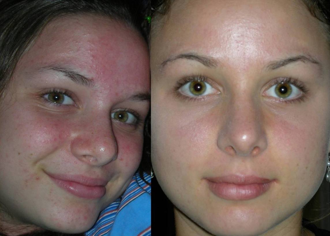 До и после дермабразии