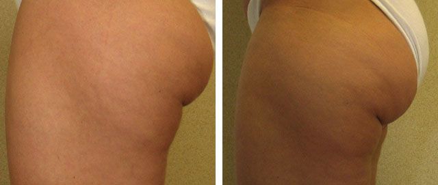 эффект липолиза