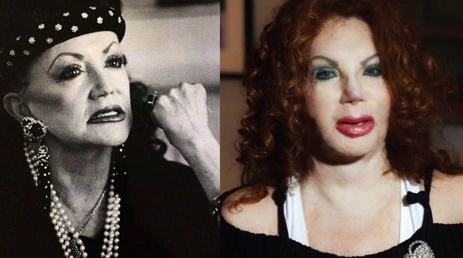 Жаклин Сталлоне ринопластика